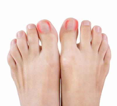 Maroochy Podiatry Clean Healthy Toenails 2