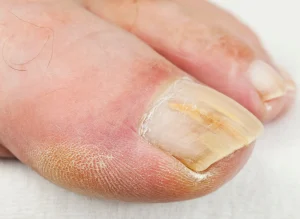 Maroochy Podiatry Fungal Nail Infection