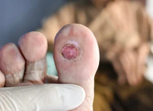 Maroochy Podiatry Ulcers