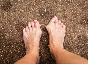 Maroochy Podiatry bunions and toe deformities