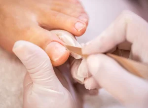 Maroochy Podiatry ingrown toenails